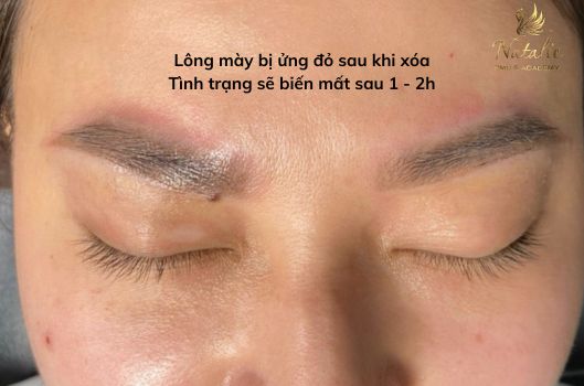 xoa-laser-long-may-bi-do-co-sao-khong (1)